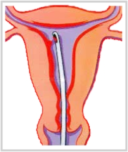 Endometrial Biopsy