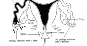 hysterosalpingogram