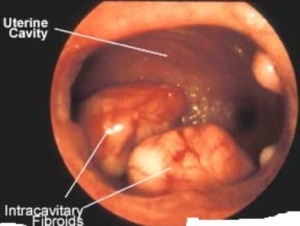 hysteroscopy