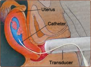 sonohysterogram