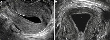 What Is A Saline Infusion Sonohysterogram Sis Helping To Create New Beginnings Fertility Institute Of Hawaii