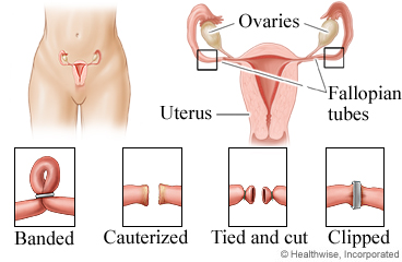 Bilateral Tubal Ligation Helping To Create New Beginnings Fertility Institute Of Hawaii