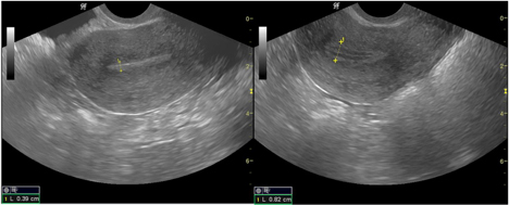 ultra sound